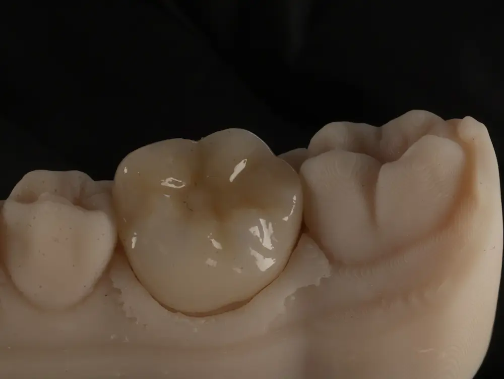 Dental Crown