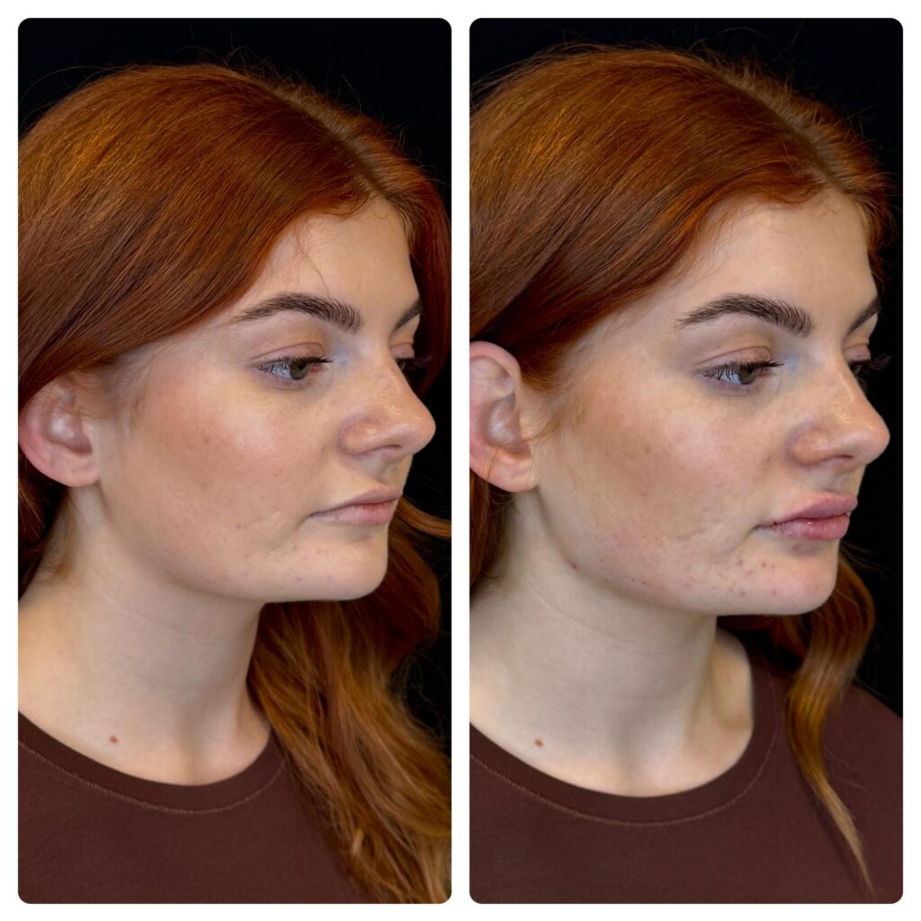 Jaw & Lip Filler By Dr Cat at Face & Teeth, Birmingham