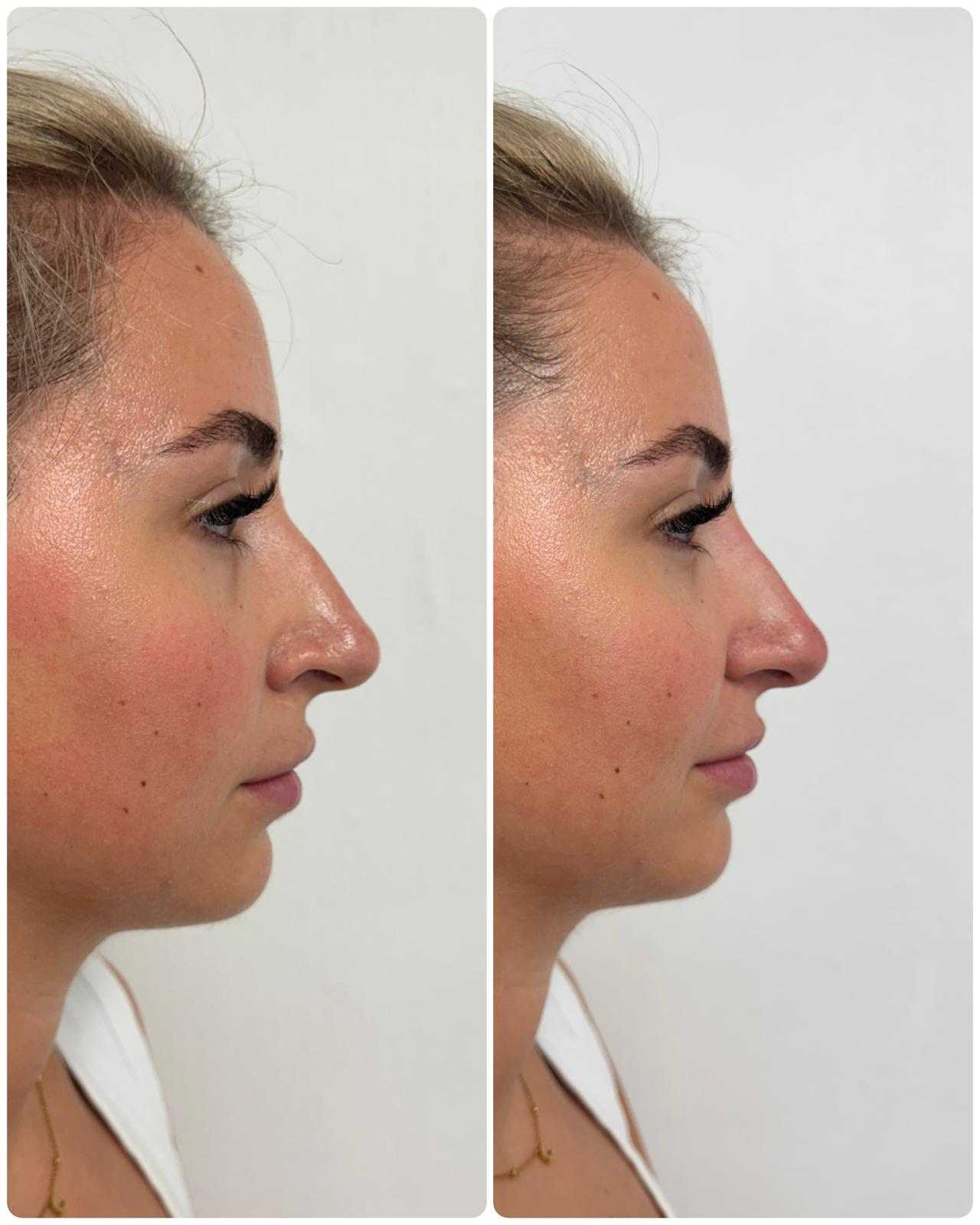 Nose filler By Dr Cat at Face & Teeth, Birmingham Nose filler By Dr Cat at Face & Teeth, Birmingham