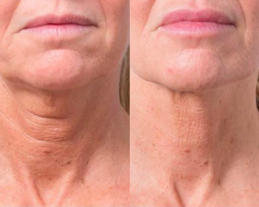 Profhilo Skin Boosters Results