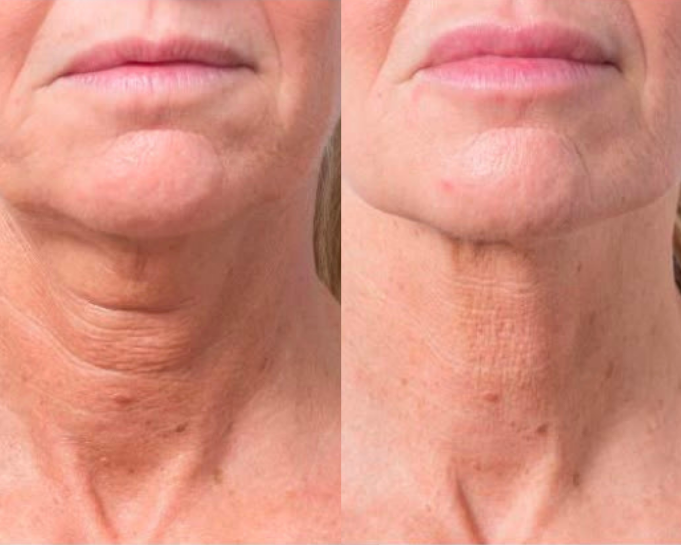 Profhilo Skin Boosters Results (1) Profhilo Skin Boosters Results