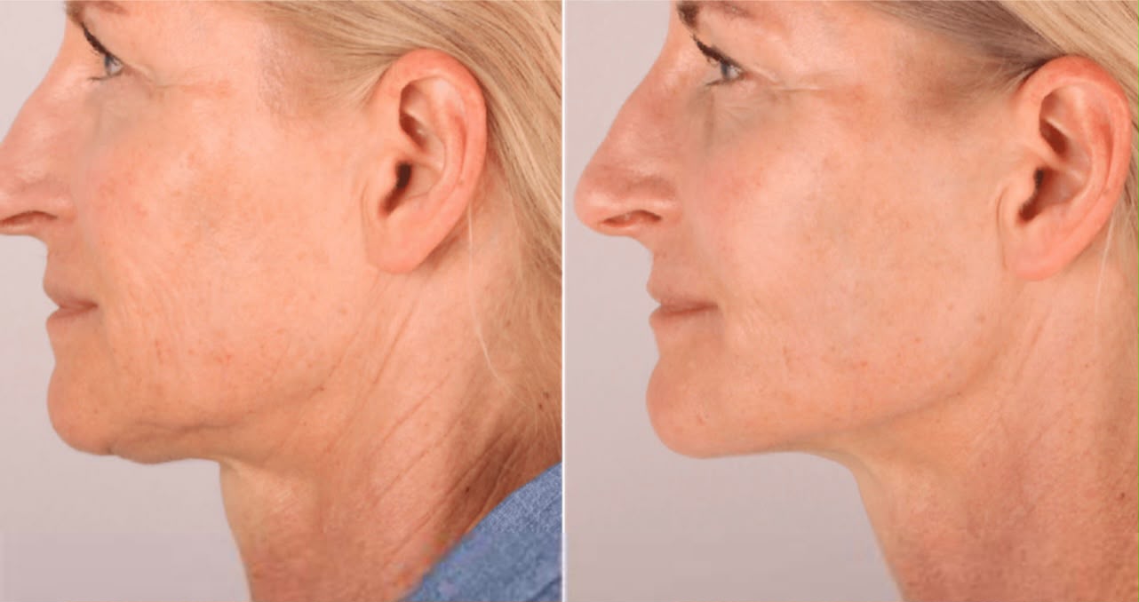 Radiesse Skin Booster- Dr Cat side view