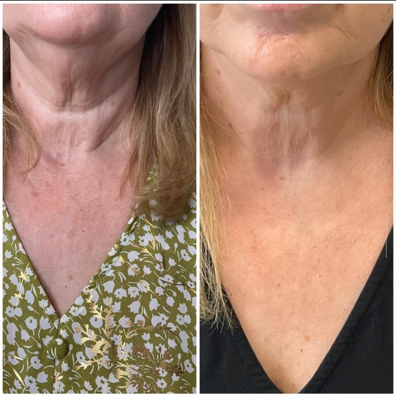 Radiesse Skin Booster Results by Dr Cat