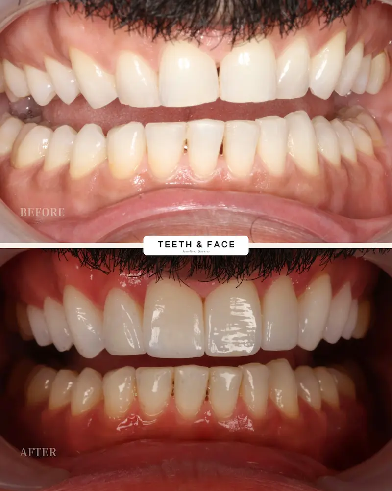 Teeth & Face Before’s & After Veneers – pope invs bonding (2) Teeth & Face Before's & After Veneers - pope invs bonding