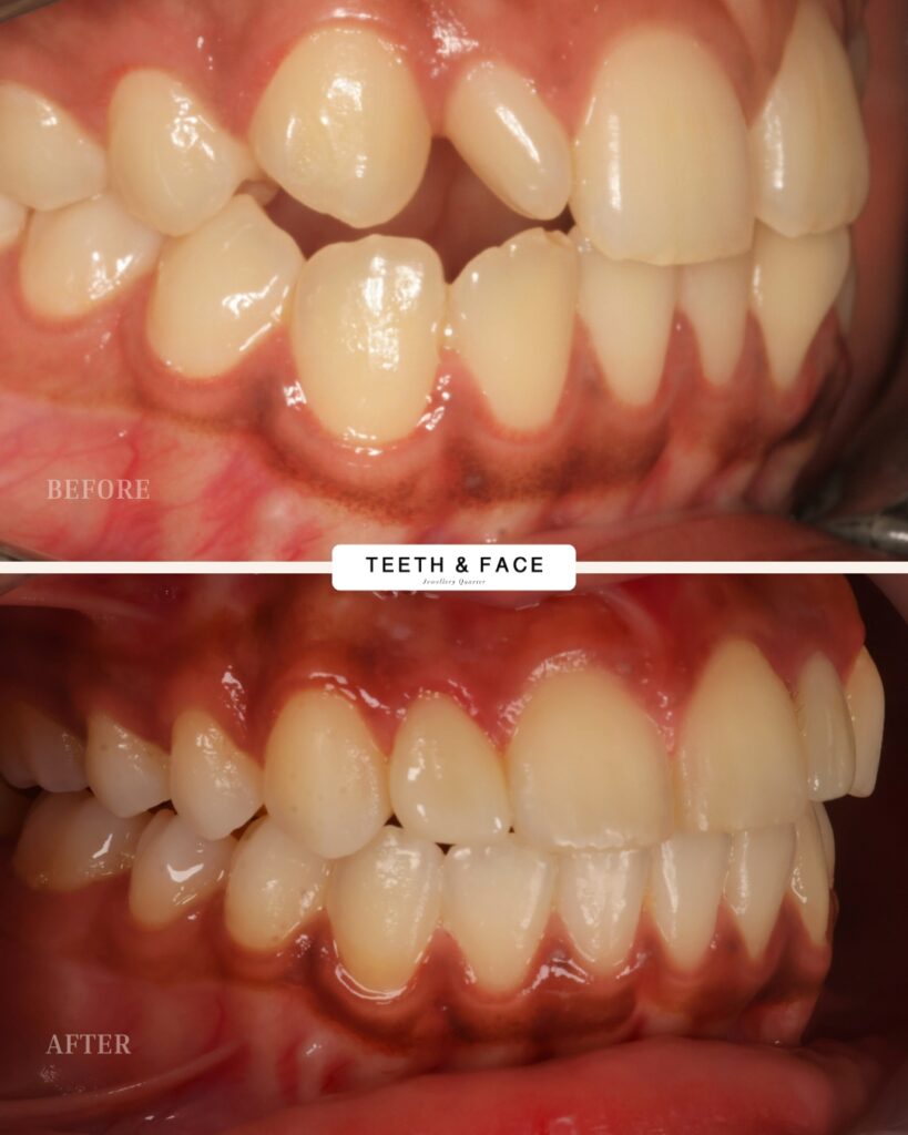 Invisalign, Crown, Bridge Result