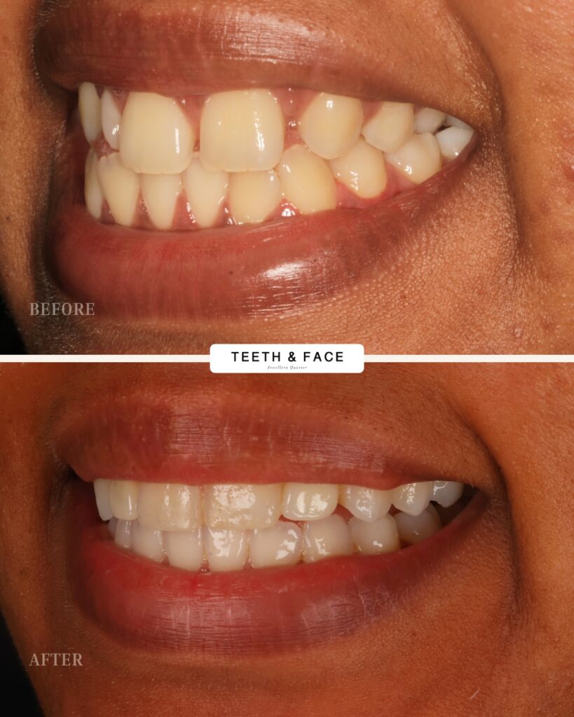 Invisalign, Crown, Bridge Result