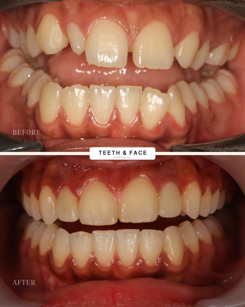 Invisalign, Crown, Bridge Result