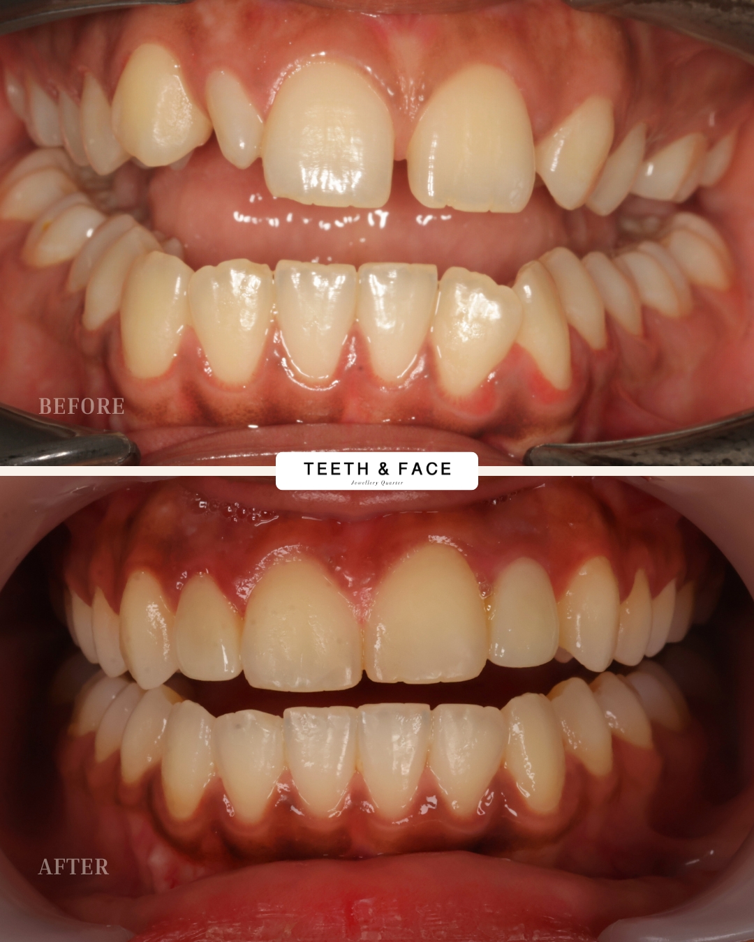 Invisalign, Crown, Bridge Result