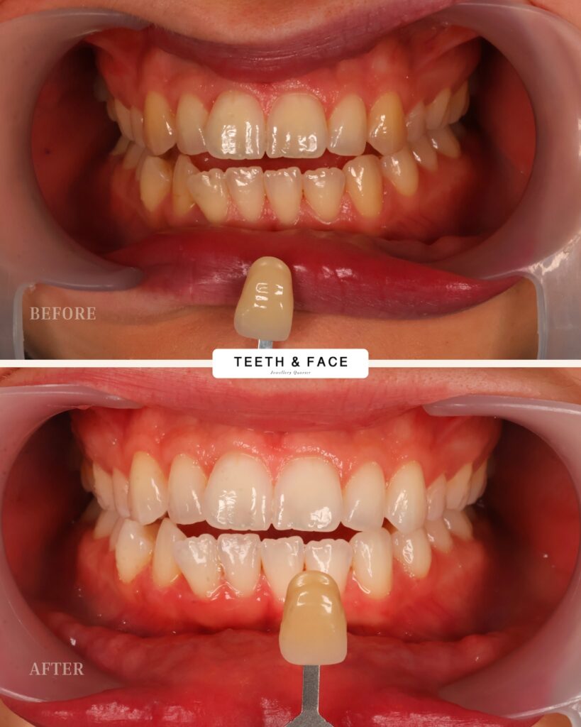 Teeth Whitening Result
