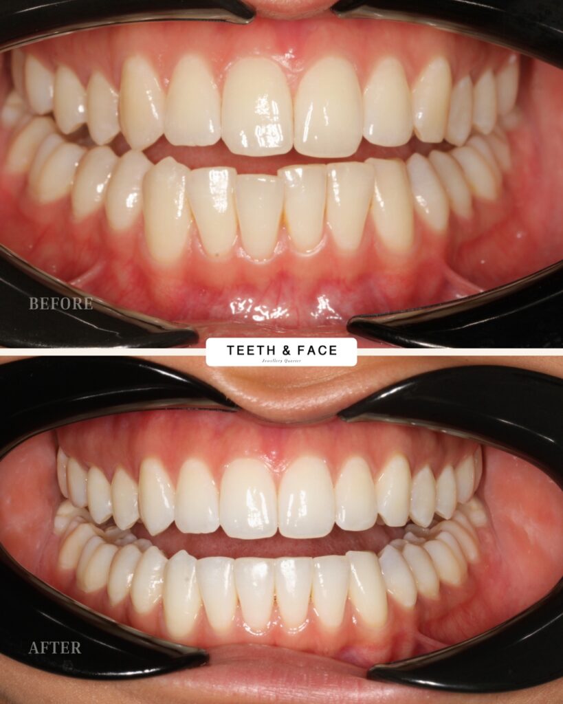 Invisalign