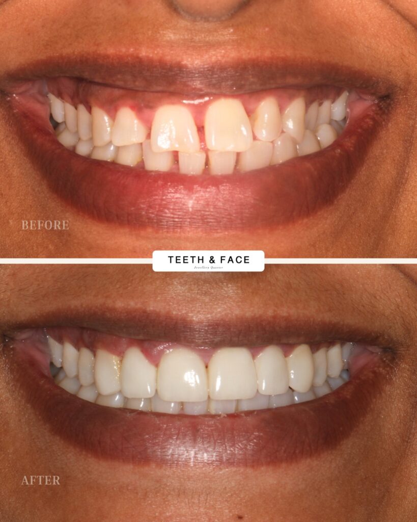 Dental Veneers results at teeth & face Birmingham