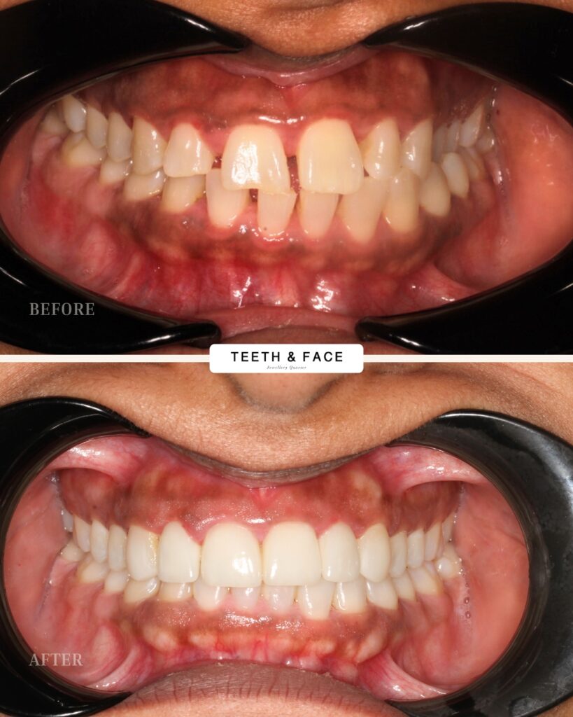 Veneers