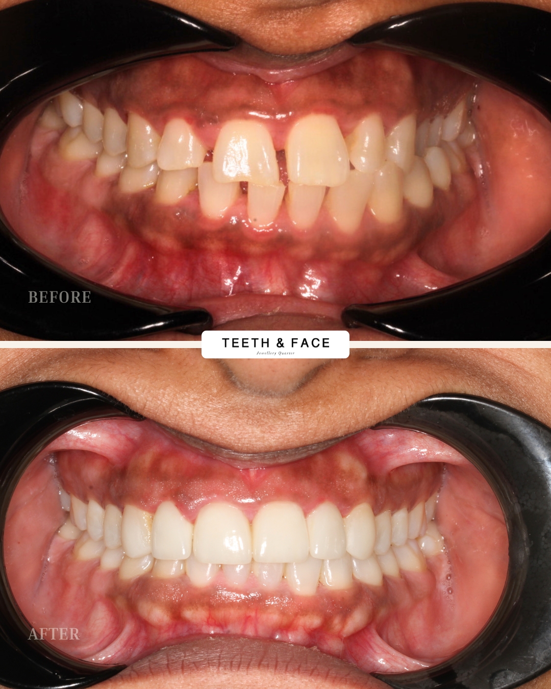 Veneers