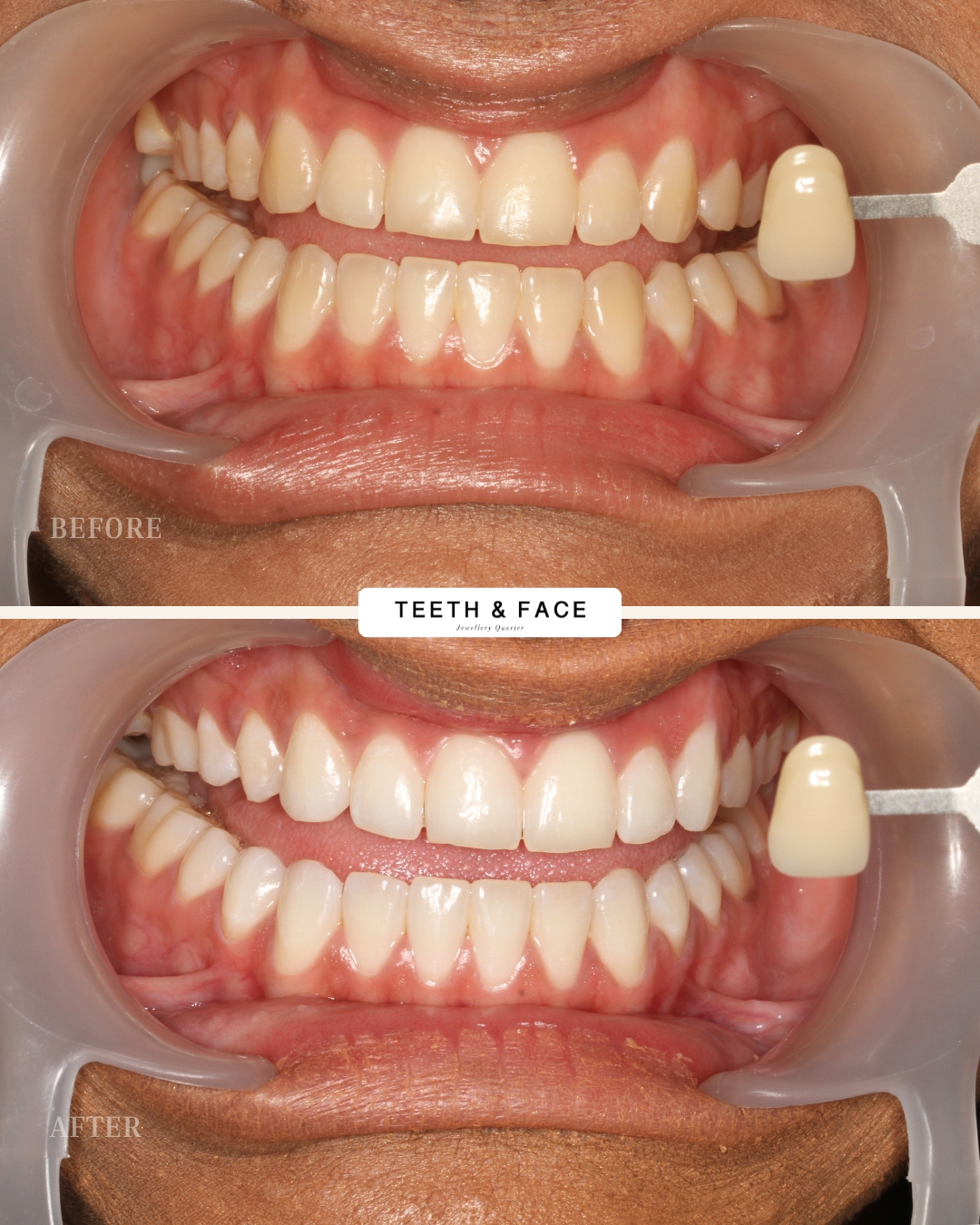 Teeth Whitening Result