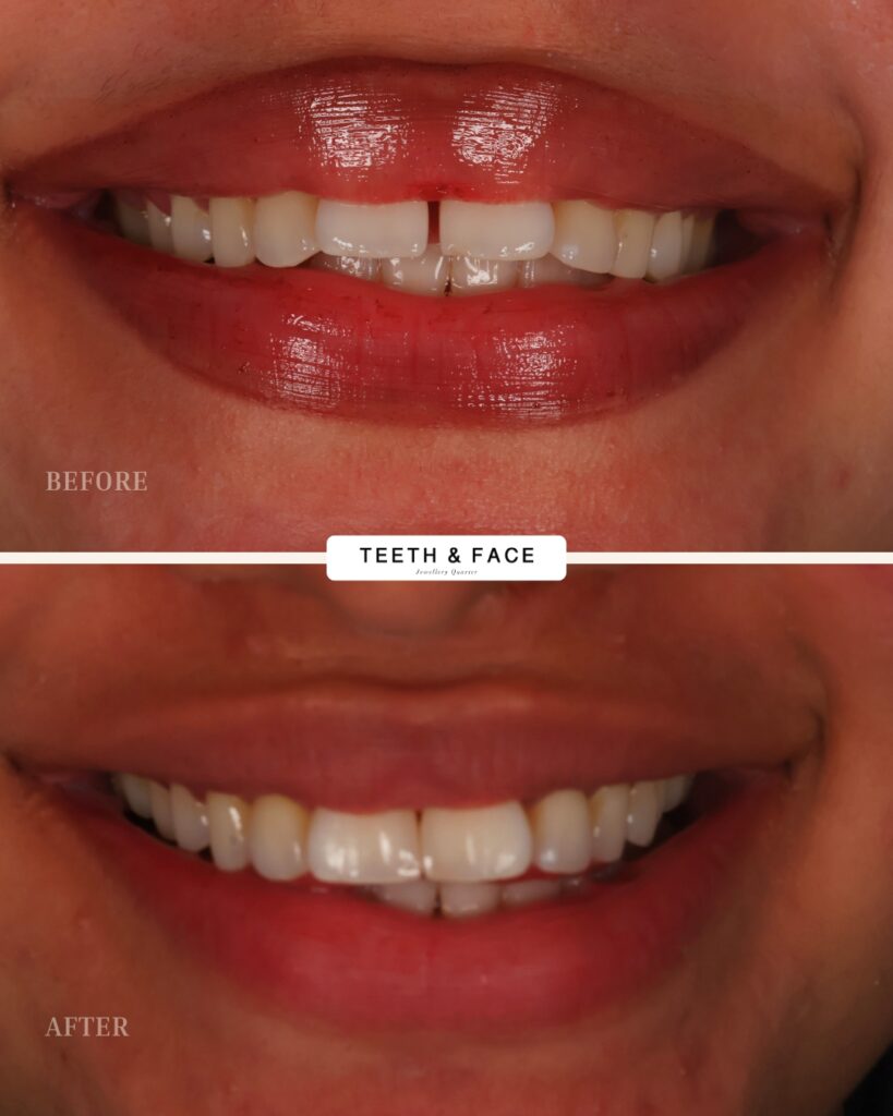 Composite Bonding