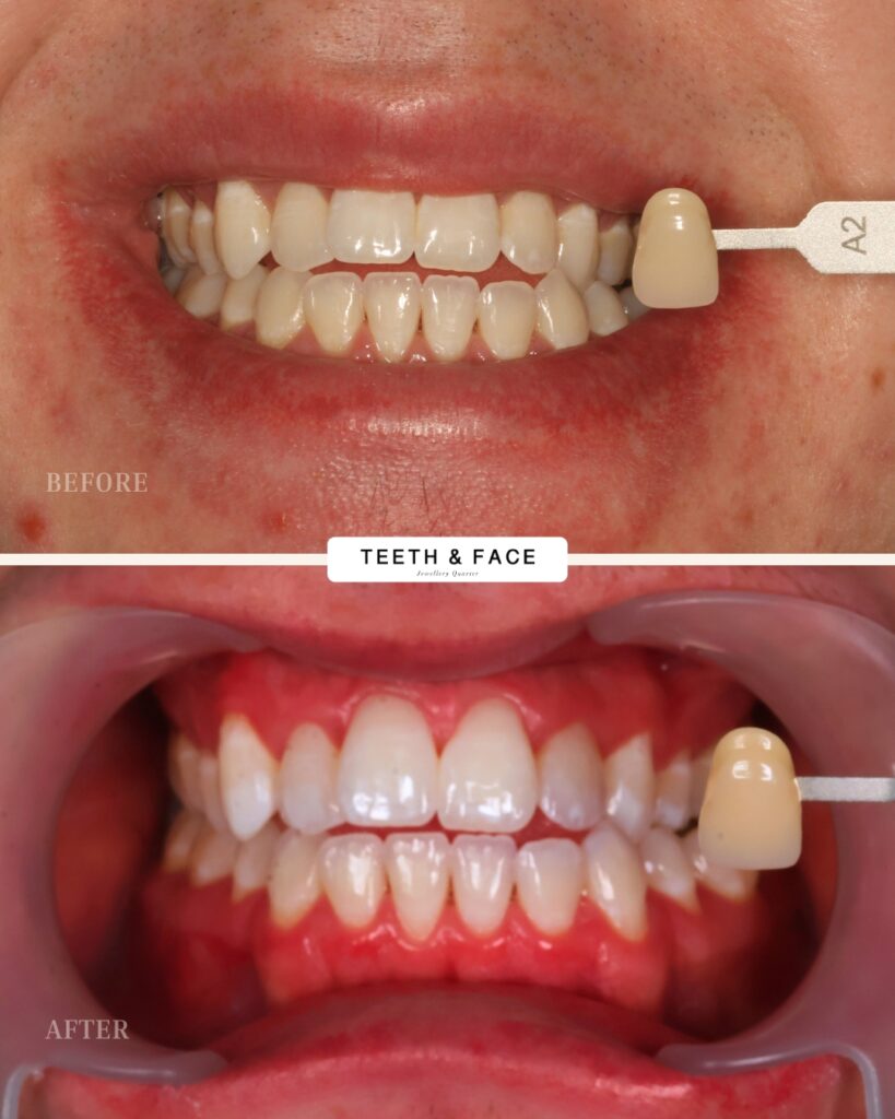 Teeth Whitening Result