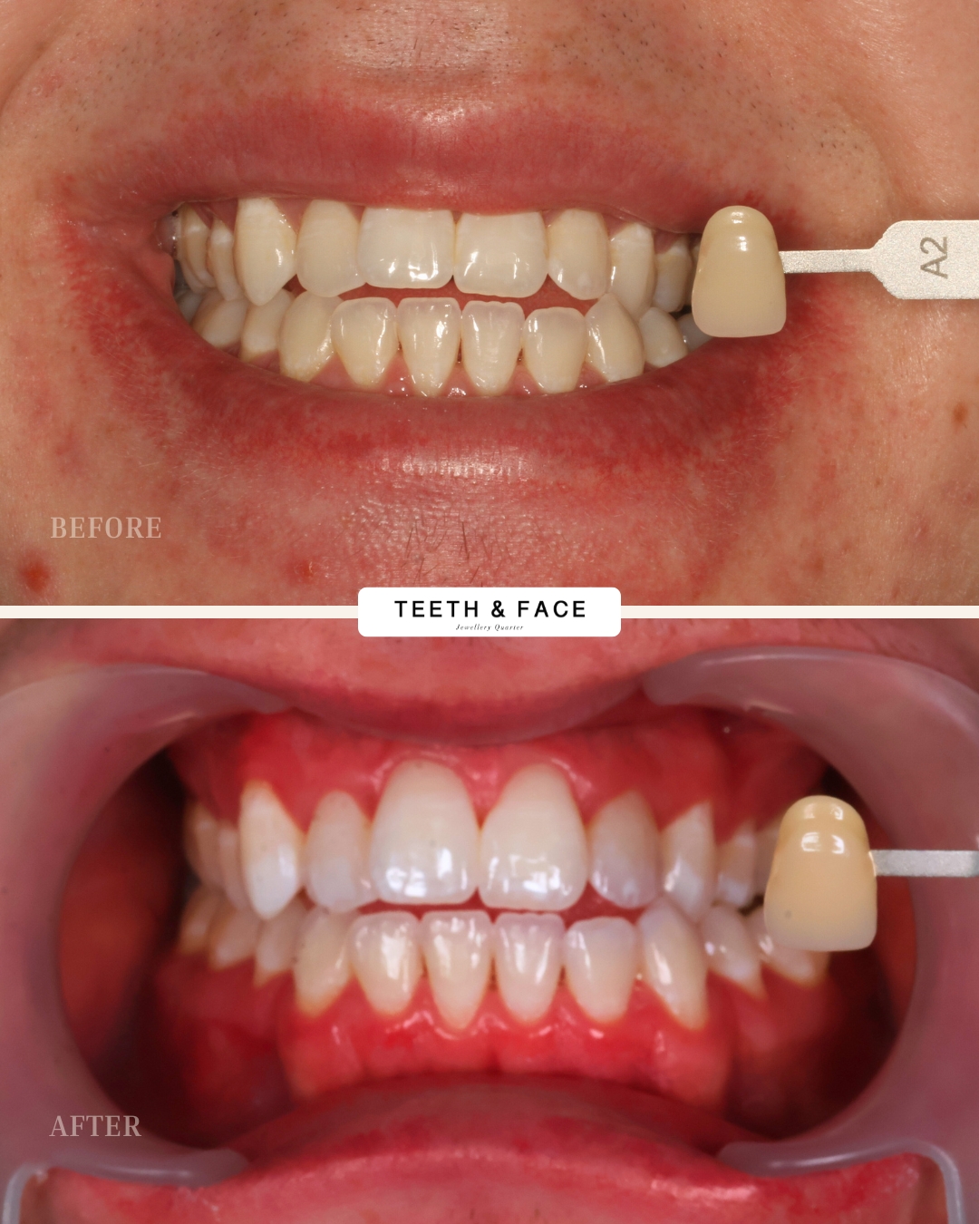 Teeth Whitening Result