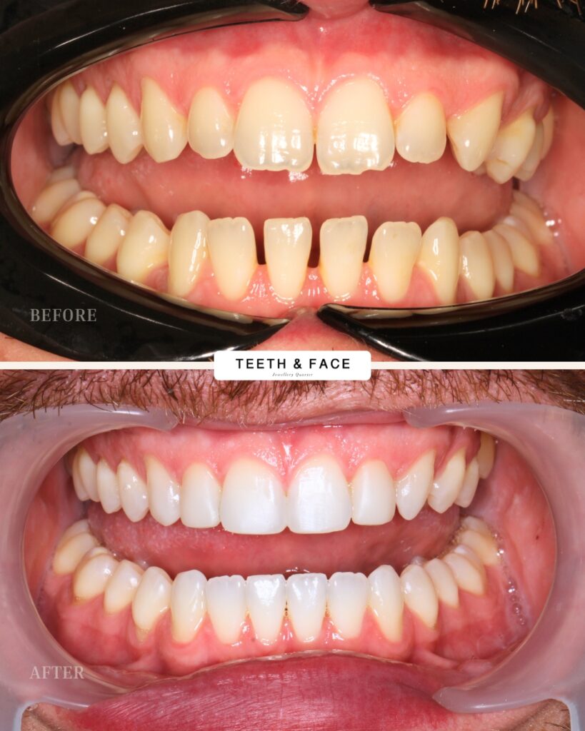 Composite Bonding, Invisalign
