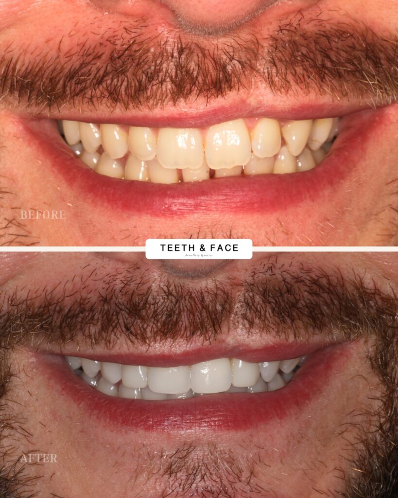 Invisalign, Composite Bonding