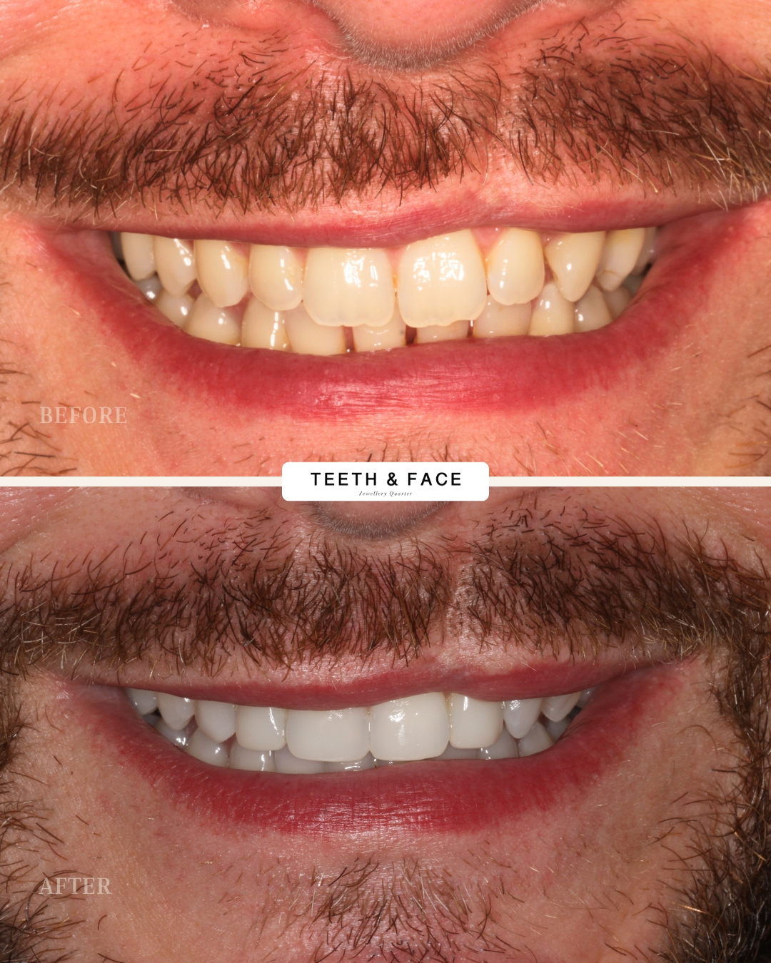 Invisalign, Composite Bonding