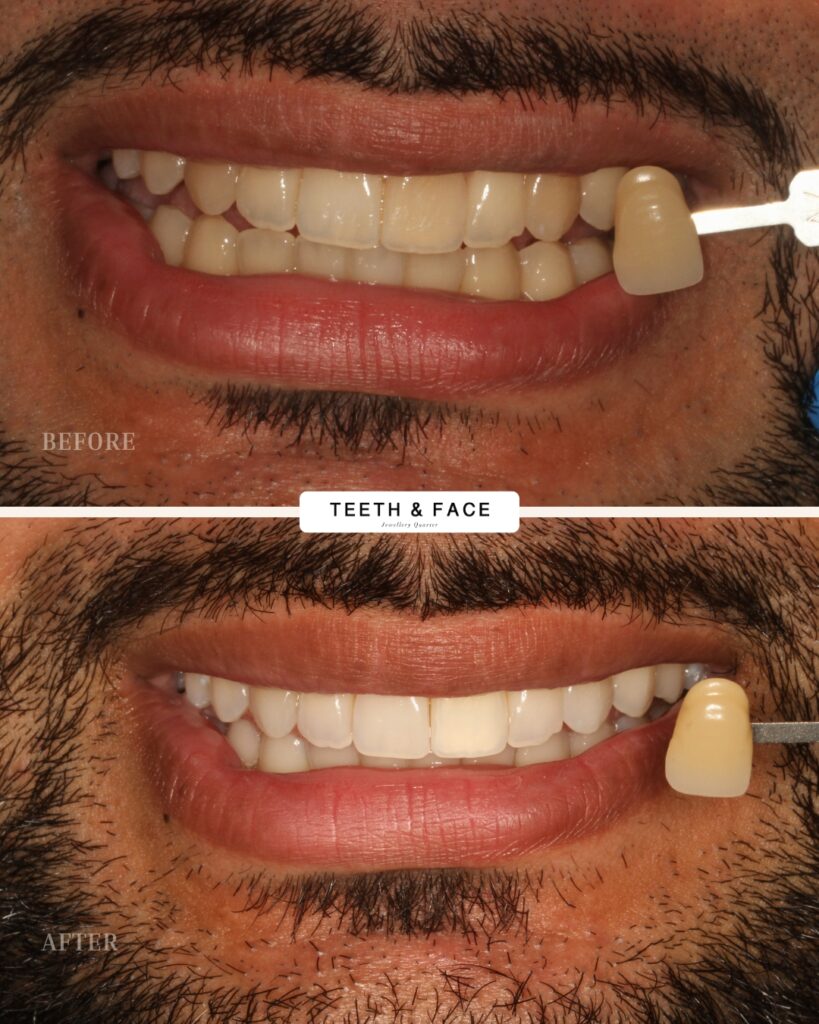 Teeth Whitening