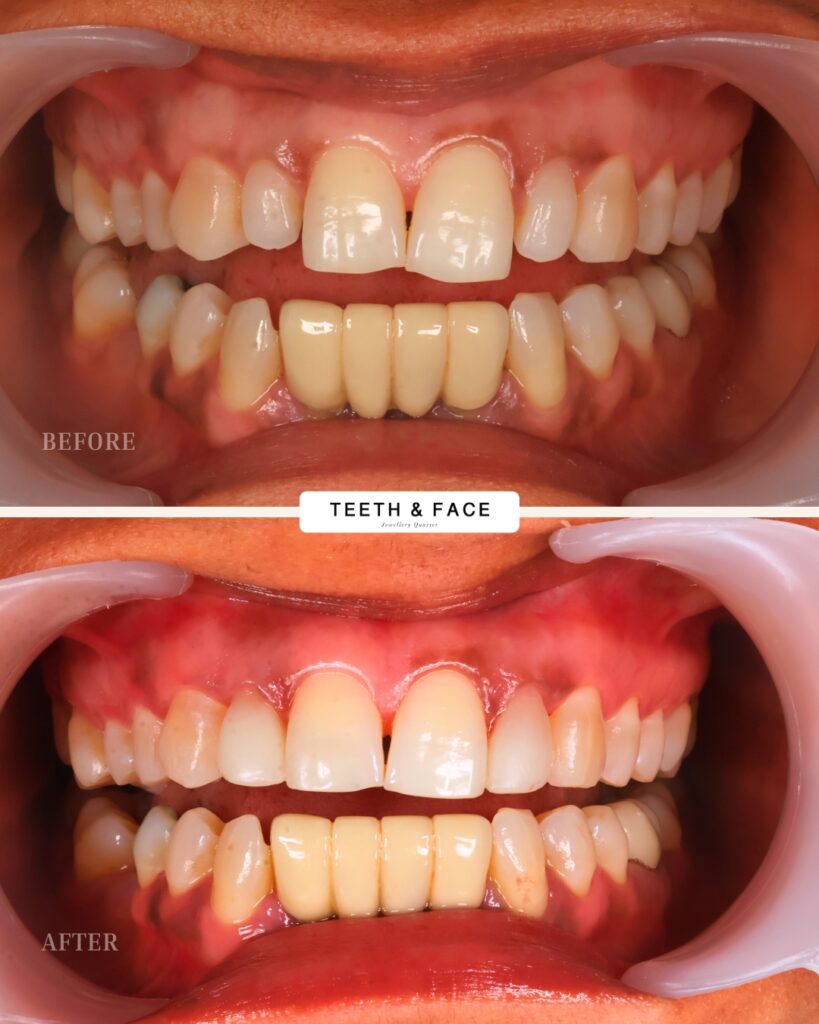 Composite Bonding & Enamel Contouring
