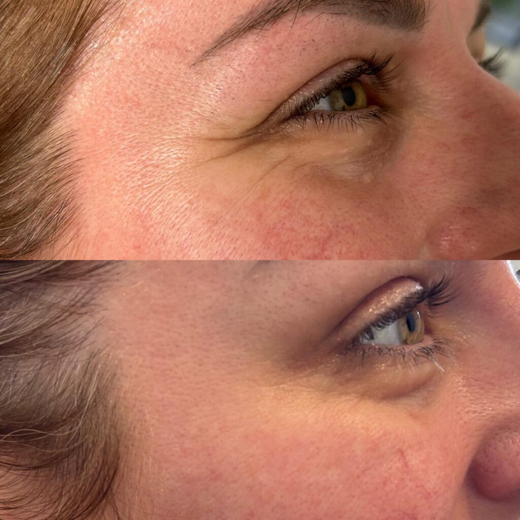 Anti-wrinkle treatment results 6