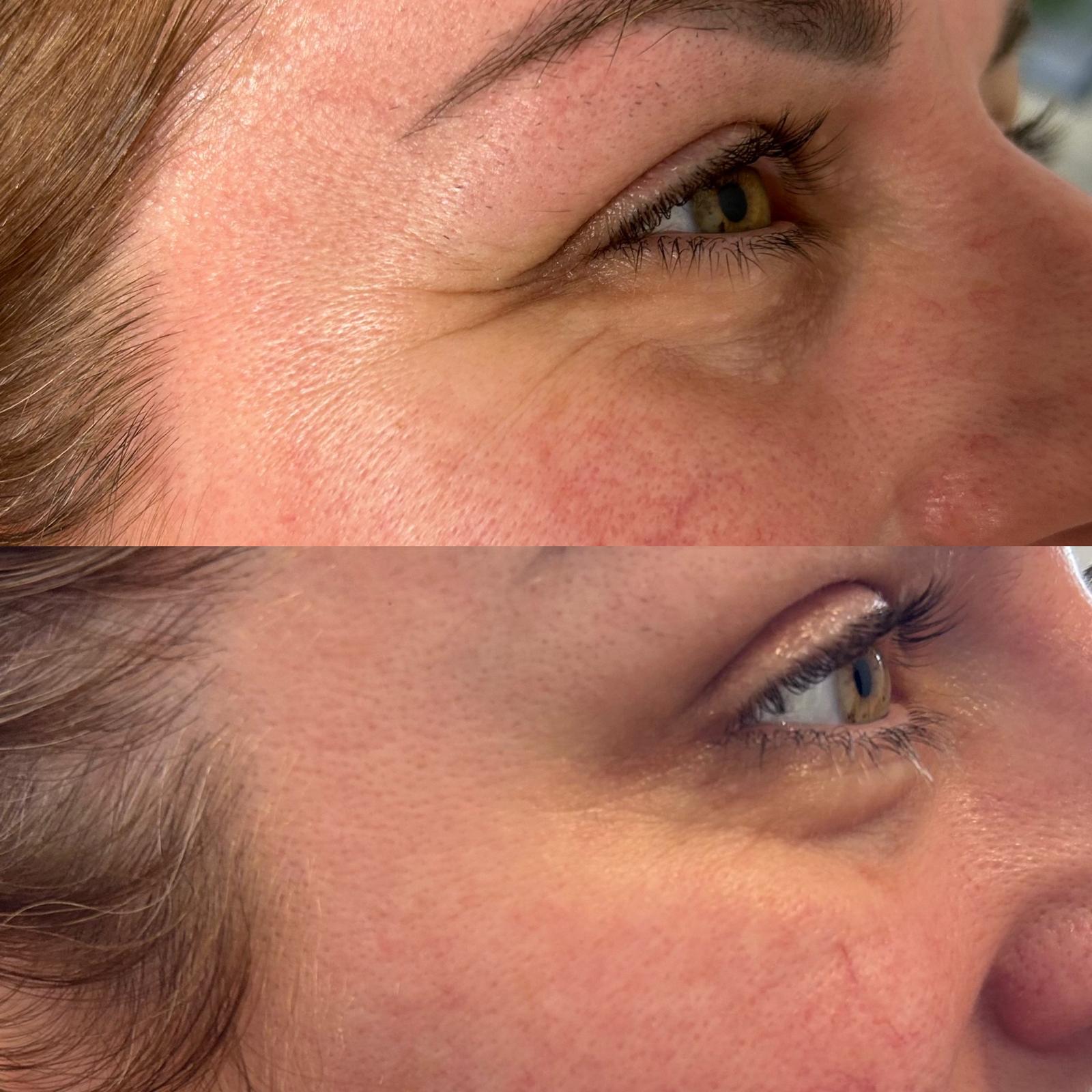 Anti-wrinkle treatment results 6 Anti-wrinkle treatment results 6