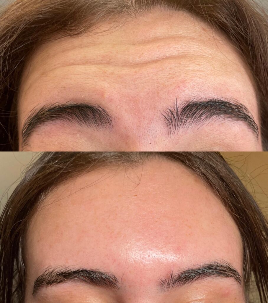 Anti-wrinkle treatment results1