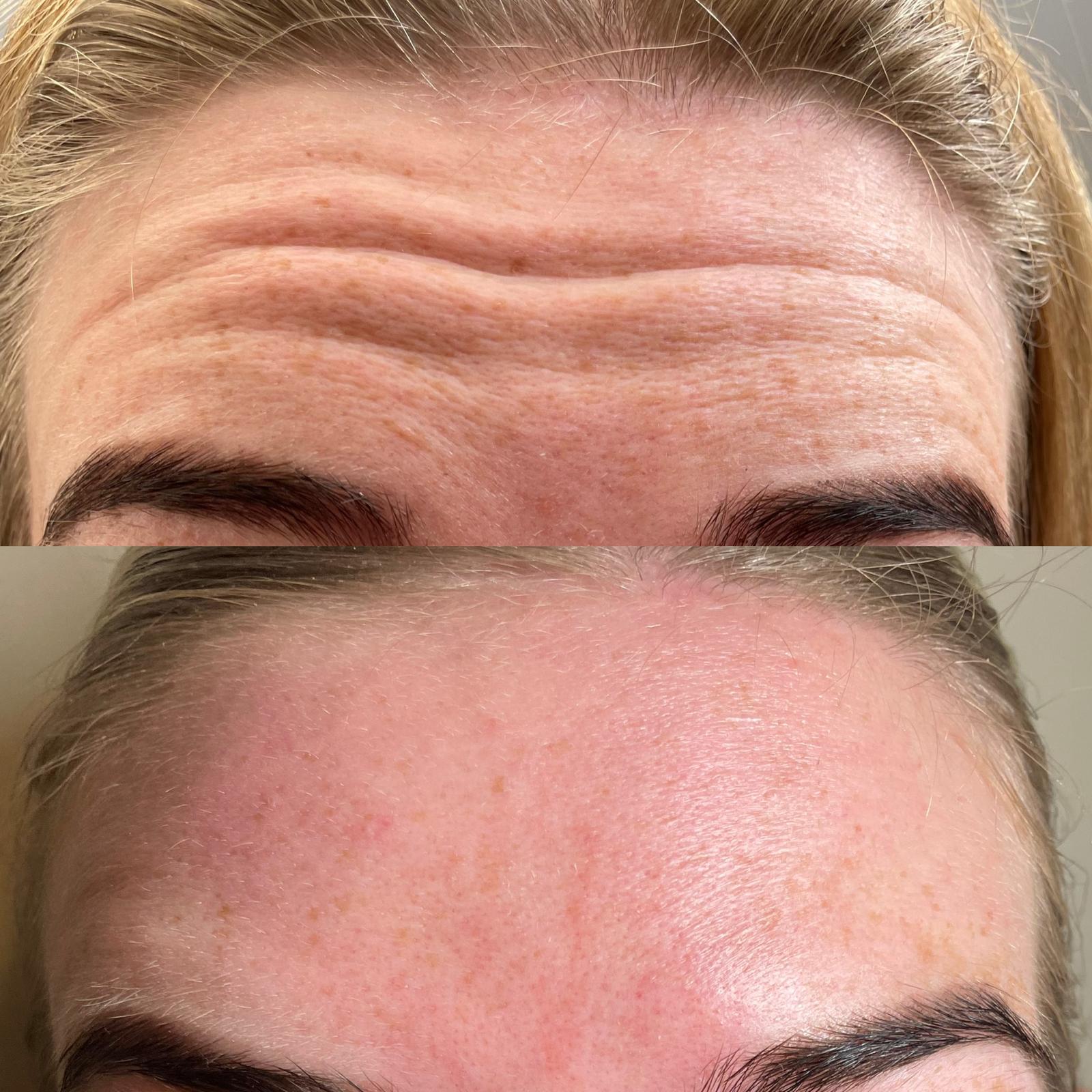 Anti-wrinkle treatment results2 Anti-wrinkle treatment results 2