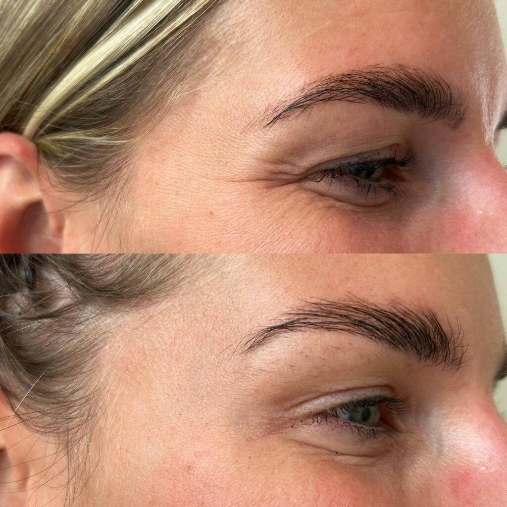 Anti-wrinkle treatment results 5
