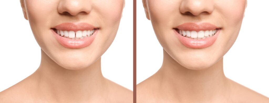 Can Teeth Gaps Be Closed With Composite Bonding?